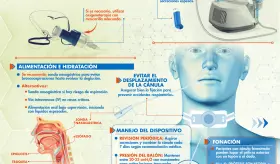 PACIENTE CON CÁNULA