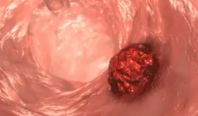 Cuatro síntomas clave del cáncer de colon en personas menores de 50 años  