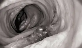 ¿Qué causa el cáncer colorrectal? Edad, genética, obesidad y  otros factores 