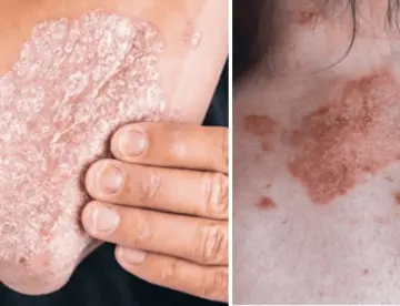 Manejo de la inflamación crónica en la psoriasis: Estrategias probadas para lograr periodos de remisión