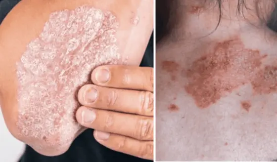 Manejo de la inflamación crónica en la psoriasis: Estrategias probadas para lograr periodos de remisión