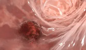 Test no invasivo detecta sangre oculta en las heces optimizando la detección temprana de cáncer de colon