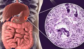 Nueva terapia podría reducir los tumores en cáncer gastrointestinal metastásico: Estudio