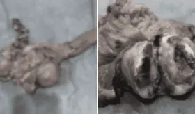 Diagnostican gastrinoma pancreático en paciente con úlcera péptica que ocasionaba hematemesis y melena