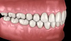 Crean dientes humanos en laboratorio con células del propio paciente: Más fuertes y sin riesgo de rechazo