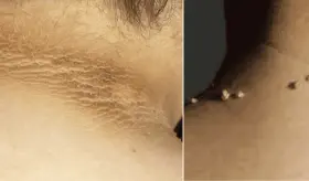Verrugas y manchas oscuras en el cuello: Las se&ntilde;ales que anticipan el diagn&oacute;stico de diabetes tipo 2