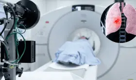 Proponen un cribado universal de cáncer de pulmón para reducir mortalidad y mejorar el diagnóstico precoz