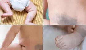 ¿Qué es la mancha de Baltz? Lesión cutánea benigna azulada y común en recién nacidos