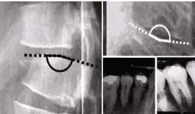 Pérdida de estatura y fracturas costales por tos como manifestaciones iniciales de osteoporosis
