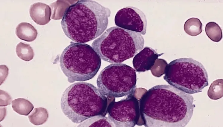 Prueba de médula ósea podría duplicar la supervivencia en jóvenes con leucemia mieloide aguda Prueba de médula ósea podría duplicar la supervivencia en jóvenes con leucemia mieloide aguda