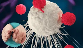 Terapia CAR-T salva por primera vez en el mundo a niña de 11 años con dermatomiositis anti-MDA5