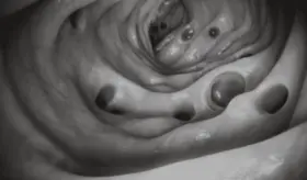 Descubren cómo la degradación de la proteína p53 desencadena el cáncer de colon en etapas tempranas 