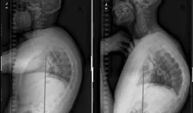 Envejecimiento vertebral: Hipercifosis puede causar pérdida de altura, dolor  y discapacidad funcional