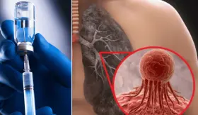 Investigadores desarrollan primera vacuna terapéutica contra el cáncer de pulmón