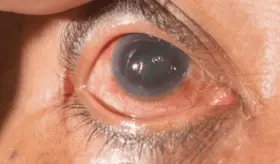 Científicos descubren que el daño en el glaucoma estaría relacionado con un metabolismo retinal alterado