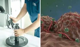 Oncothermia: Terapia no invasiva que usa radiofrecuencia para destruir tumores sin afectar tejidos sanos