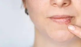 Progreso en el Desarrollo de una Vacuna contra el Herpes