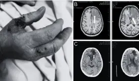 Paciente presentó reactivación de toxoplasmosis cerebral 8 años después de trasplante renal