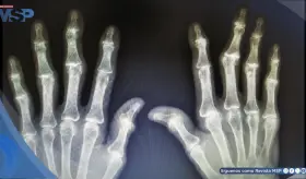 Desigualdad de acceso económico a servicios médicos en artritis reumatoide por género y seguro: estudio