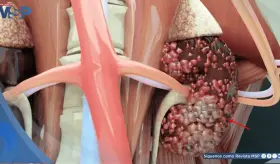 La inmunoterapia eleva al 40% la supervivencia a 5 años en cáncer renal metastásico, según expertos  