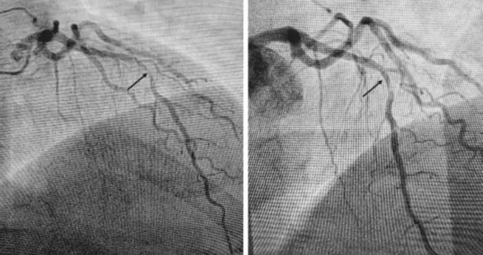 Paciente diabético con isquemia transitoria no diagnosticable por ECG desarrolla oclusión coronaria