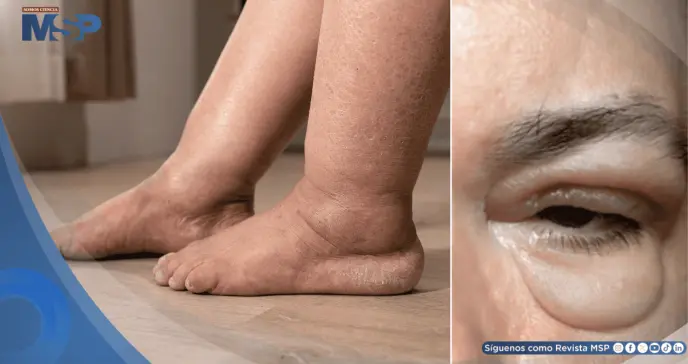 ¿Hinchazón en piernas o párpados? Podría ser edema, la primera alerta de falla cardíaca, renal o hepática ¿Hinchazón en piernas o párpados? Podría ser edema, la primera alerta de falla cardíaca, renal o hepática