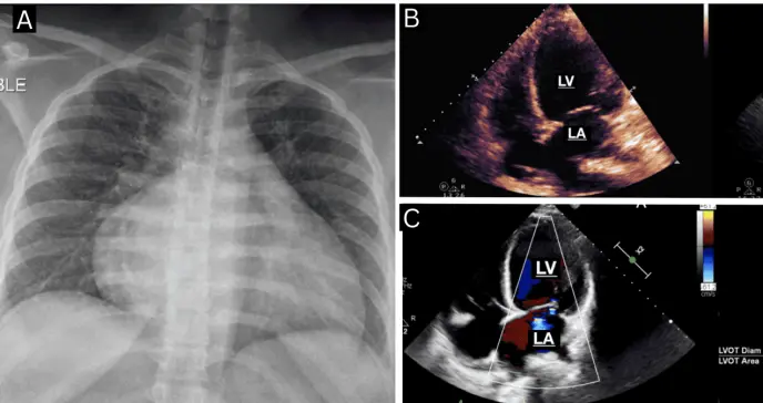 Disfunción multiorgánica secundaria a miocardiopatía periparto en mujer puertorriqueña previamente sana