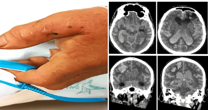 Hombre de 80 años presenta hemorragia intracerebral tras mordedura de serpiente Bothrops asper