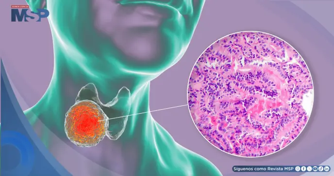 Carcinoma Papilar Tiroideo: epidemiología, factores de riesgo y manejo basado en evidencia