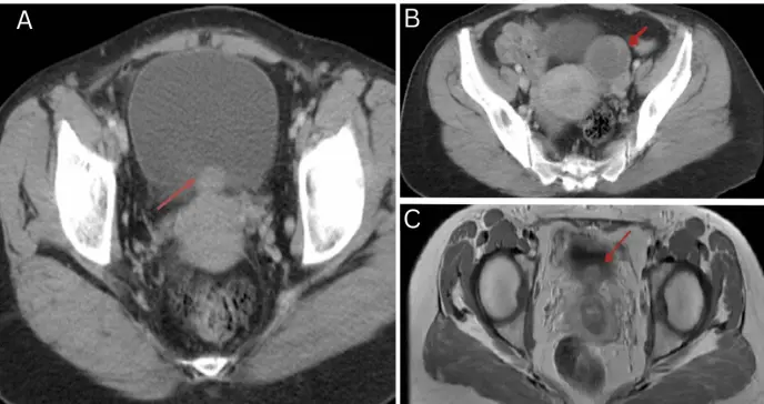Síntomas urinarios persistentes sin patrón menstrual revelaron endometriosis vesical en mujer de 37 años