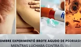 Hombre experimentó brote agudo de psoriasis mientras luchaba contra VIH
