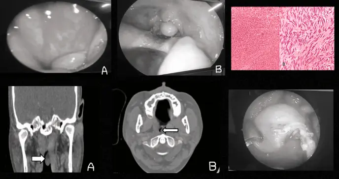 Descubren schwannoma nasofaríngeo en paciente con anosmia y cefalea crónica que simulaba rinosinusitis Descubren schwannoma nasofaríngeo en paciente con anosmia y cefalea crónica que simulaba rinosinusitis