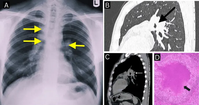 Tos, fiebre leve y pérdida de peso como presentación de tuberculosis mediastínica en mujer de 55 años