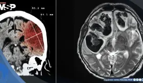 ¿Infarto o sangrado cerebral? Así se diferencian los tipos de accidente cerebrovascular