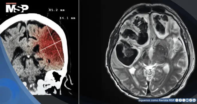 ¿Infarto o sangrado cerebral? Así se diferencian los tipos de accidente cerebrovascular