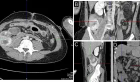 Manifestación de enfermedad de Crohn tras trauma abdominal por herida de bala en hombre de 34 años