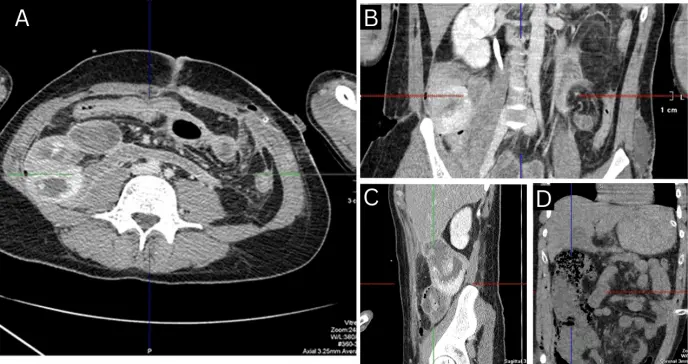 Manifestación de enfermedad de Crohn tras trauma abdominal por herida de bala en hombre de 34 años