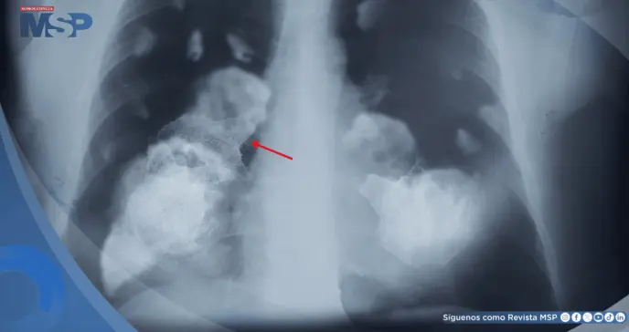 Por primera vez demuestran que la contaminación atmosférica provoca cáncer de pulmón y daño en el ADN