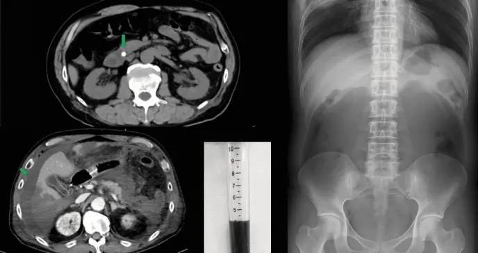 Paciente con líquido abdominal negro evoluciona a fallo multiorgánico por pancreatitis aguda grave