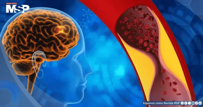 Fármaco para psoriasis muestra potencial como primer tratamiento efectivo contra la demencia vascular Fármaco para psoriasis muestra potencial como primer tratamiento efectivo contra la demencia vascular