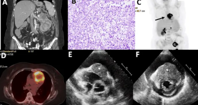 Carcinoma renal con metástasis cardíaca en mujer de 52 años con disnea súbita y taponamiento cardiaco
