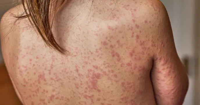 EEUU atraviesa su peor epidemia de sarampión, según universidad Johns Hopkins EEUU atraviesa su peor epidemia de sarampión, según universidad Johns Hopkins