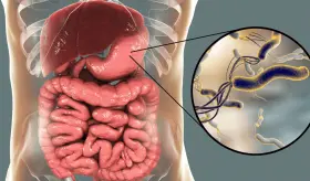 Helicobacter pylori causaría 12 millones de cánceres gástricos, pero el 75% serían evitables: Estudio