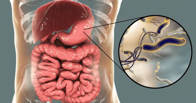 Helicobacter pylori causaría 12 millones de cánceres gástricos, pero el 75% serían evitables: Estudio Helicobacter pylori causaría 12 millones de cánceres gástricos, pero el 75% serían evitables: Estudio