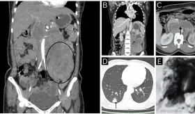Mujer con dolor lumbar es diagnosticada con leiomiosarcoma renal con invasión tumoral vascular