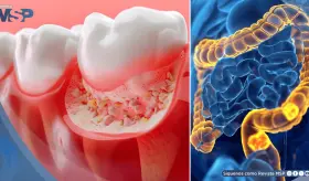 La periodontitis afecta al 69,5% de pacientes con cáncer colorrectal y aceleraría el desarrollo tumoral