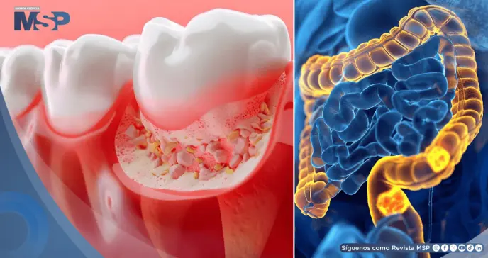 La periodontitis afecta al 69,5% de pacientes con cáncer colorrectal y aceleraría el desarrollo tumoral La periodontitis afecta al 69,5% de pacientes con cáncer colorrectal y aceleraría el desarrollo tumoral