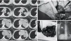 Tos persistente como manifestación clínica de teratoma mediastínico y quiste broncogénico coexistentes