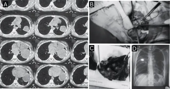 Tos persistente como manifestación clínica de teratoma mediastínico y quiste broncogénico coexistentes