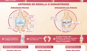 IMPACTO DE LA ARTROSIS EN LAS ARTICULACIONES